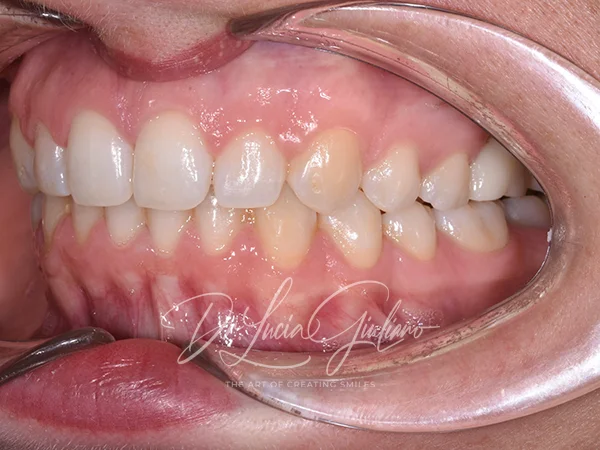 Diastema - ortodonzia trasparente