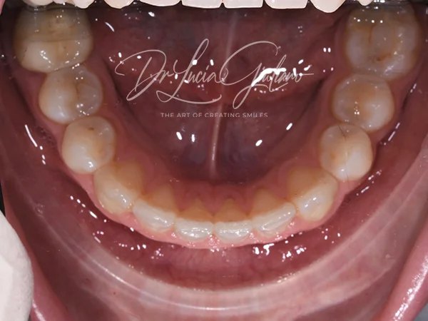 Diastema - ortodonzia trasparente