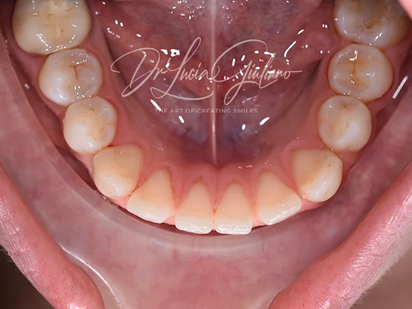 Diastema - ortodonzia trasparente